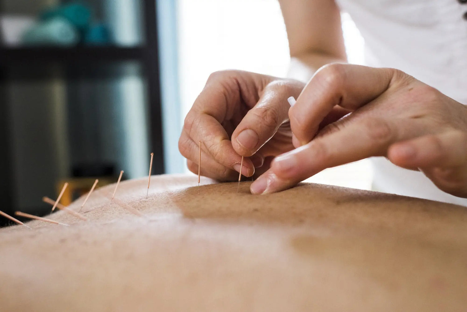 an acupuncturist using acupuncture therapy to alleviate menopause-induced hot flashes in a woman