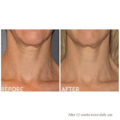 proven results of visible improvement after using EXUVIANCE Age Reverse Toning Neck Cream