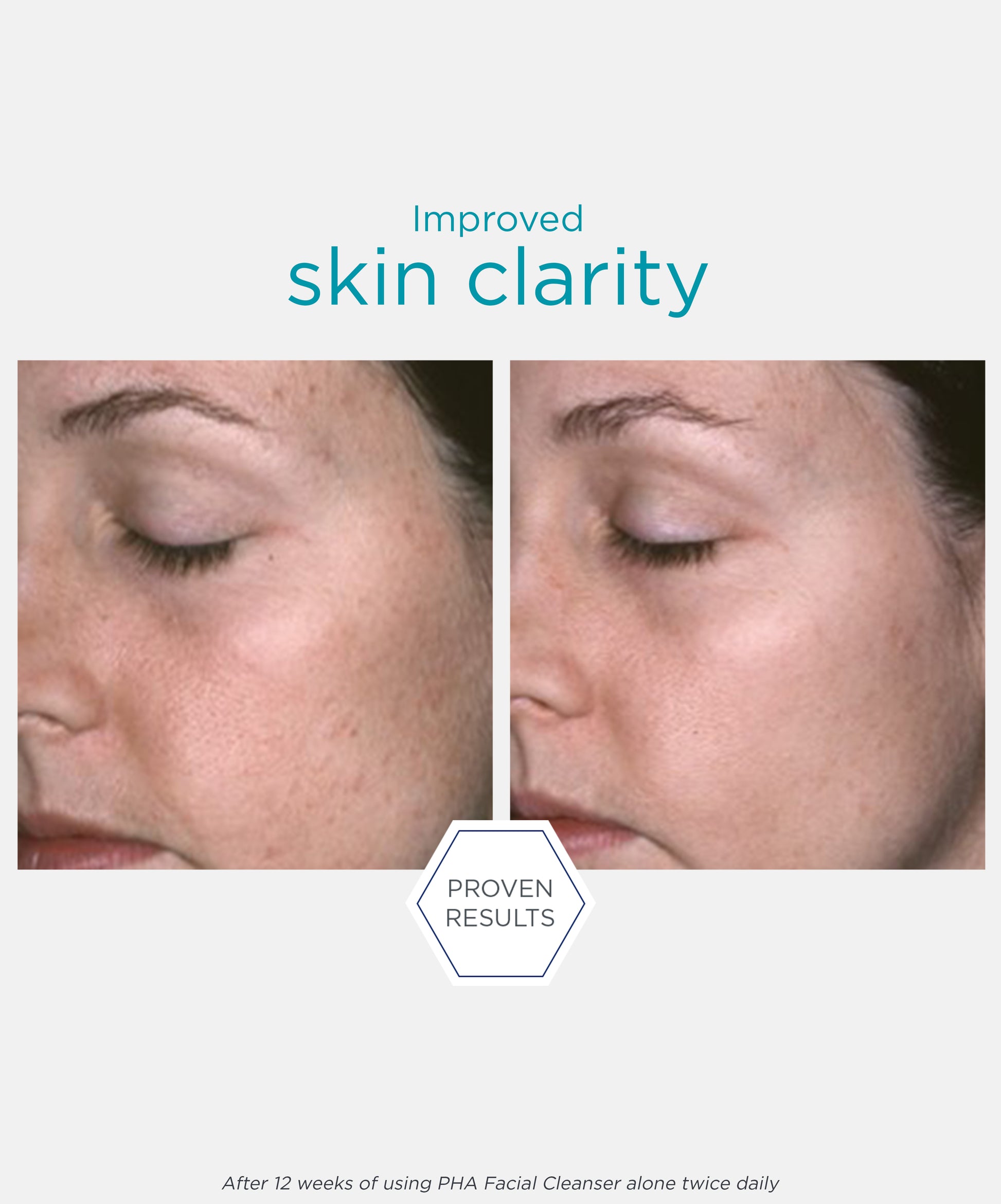 proven results of improved skin clarity after using NEOSTRATA Restore PHA Facial Cleanser Gentle Gel Facial Wash