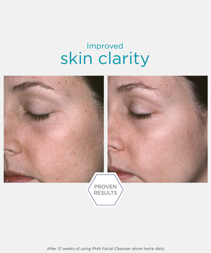 proven results of improved skin clarity after using NEOSTRATA Restore PHA Facial Cleanser Gentle Gel Facial Wash