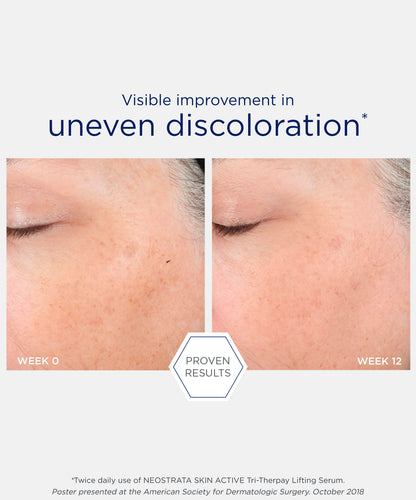 proven results of visible improvement in uneven discoloration after using NEOSTRATA Skin Active Firming Tri-Therapy Lifting Serum