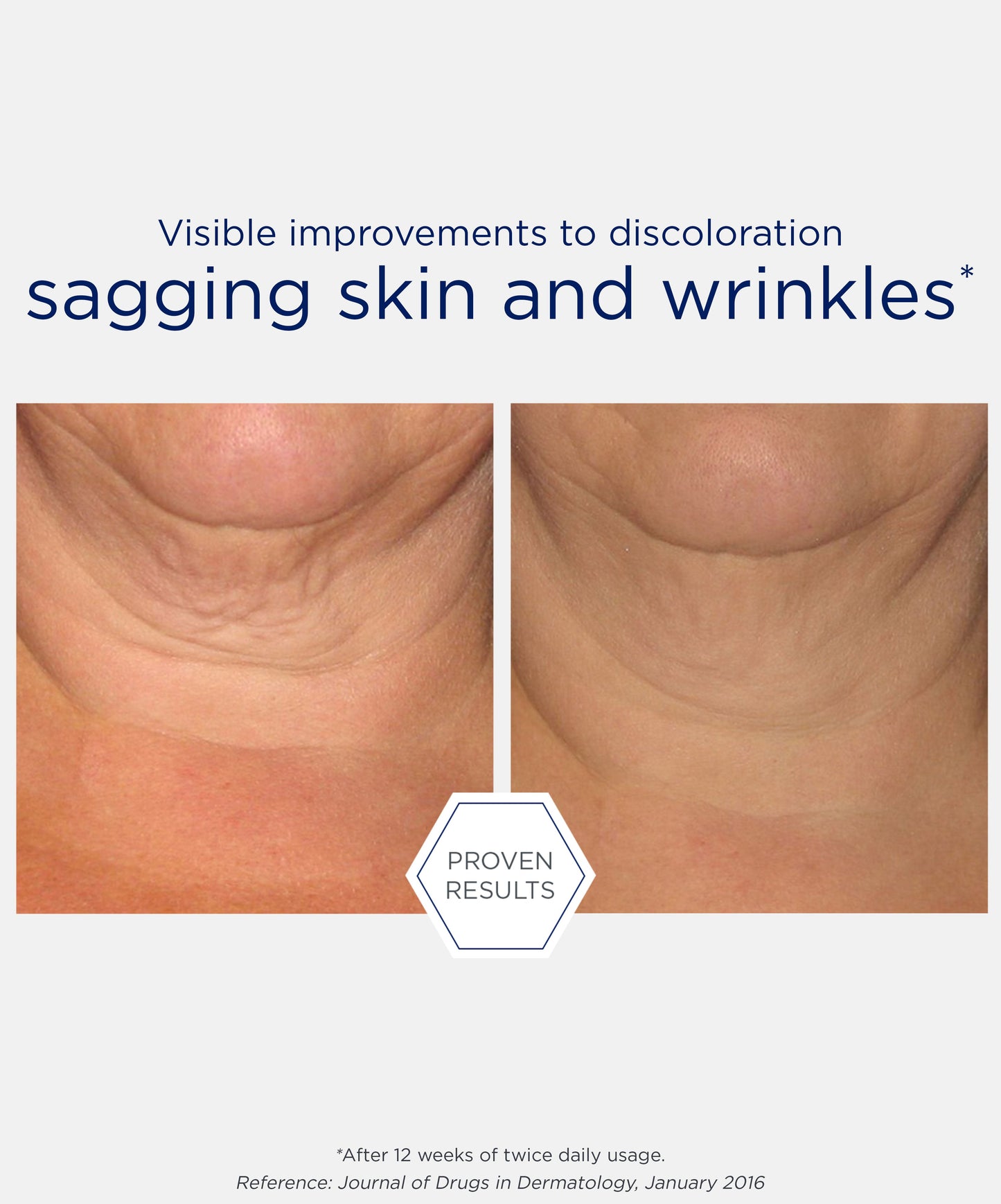 proven results of visible improvements to discoloration sagging skin and wrinkles after using NEOSTRATA Skin Active Firming Triple Firming Neck Cream